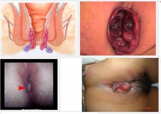 Jual Obat Ambeien Bisa Di Antar Ke Bungo