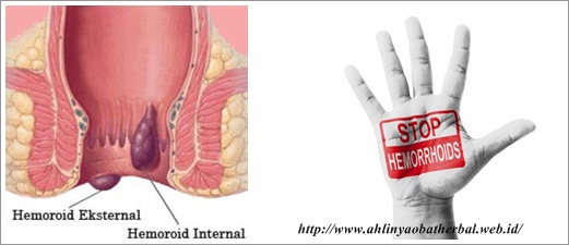 Jual Obat Ambeien Bisa Di Antar Ke Subang