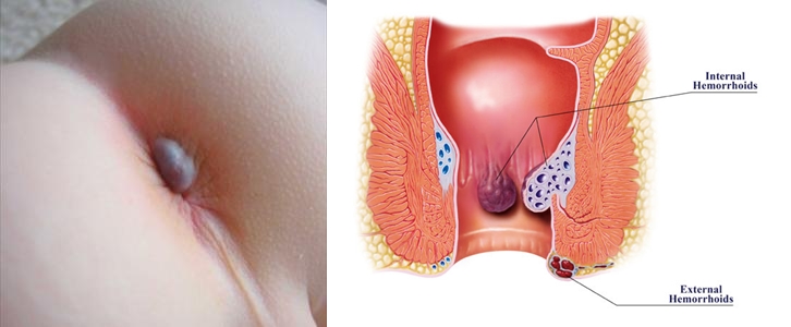 Jual Obat Ambeien Bisa Di Antar Ke Indragiri Hilir