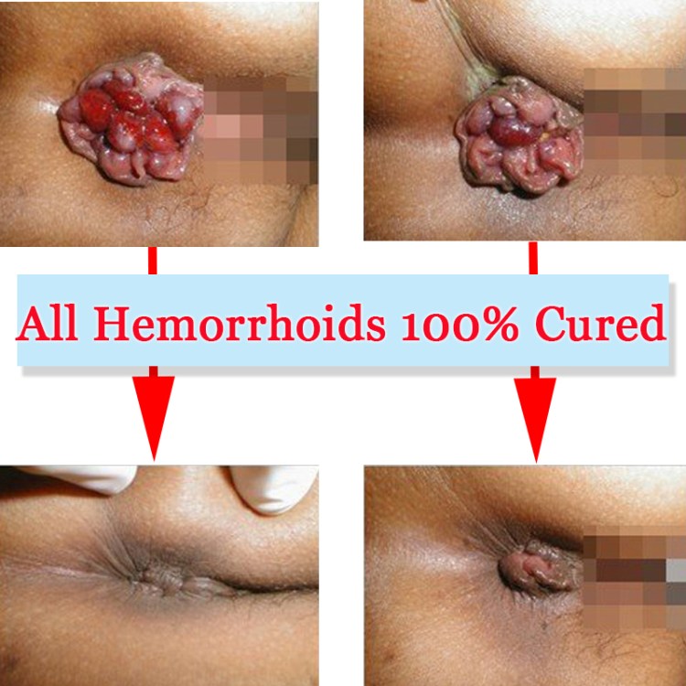 Jual Obat Ambeien Bisa Di Antar Ke Lima Puluh Kota