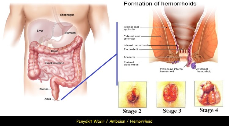 Jual Obat Ambeien Bisa Di Antar Ke Jepara