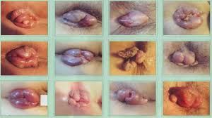 Jual Obat Ambeien Bisa Di Antar Ke Bone Bolango