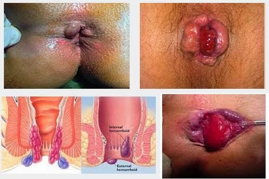 Jual Obat Ambeien Bisa Di Antar Ke Tanah Laut