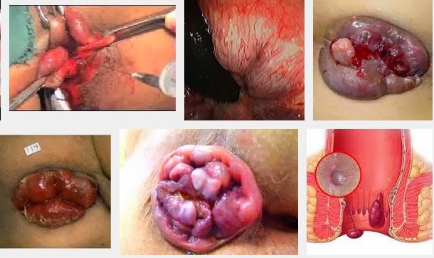 Jual Obat Ambeien Bisa Di Antar Ke Sampang