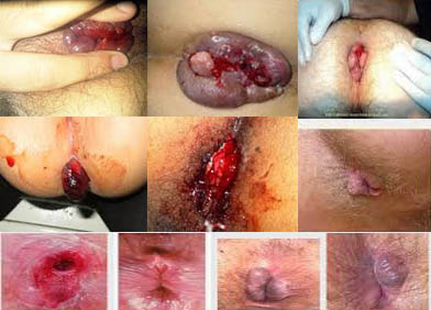 Jual Obat Ambeien Bisa Di Antar Ke Musi Banyuasin