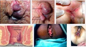 Jual Obat Ambeien Bisa Di Antar Ke Rejang Lebong