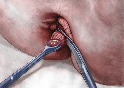 Jual Obat Ambeien Bisa Di Antar Ke Maros