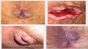 Jual Obat Ambeien Bisa Di Antar Ke Jombang