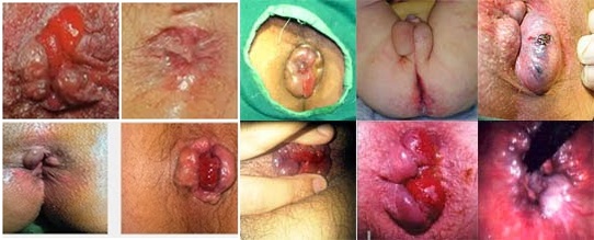 Jual Obat Ambeien Bisa Di Antar Ke Lhokseumawe