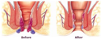 Jual Obat Ambeien Bisa Di Antar Ke Boyolali