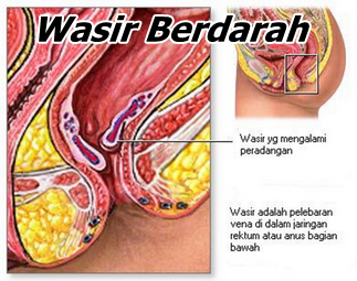 Jual Obat Ambeien Bisa Di Antar Ke Tuban